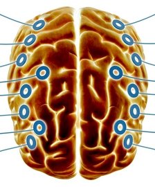 La estimulación cerebral profunda podría ayudar a curar enfermedades como el alzheimer o la depresión.