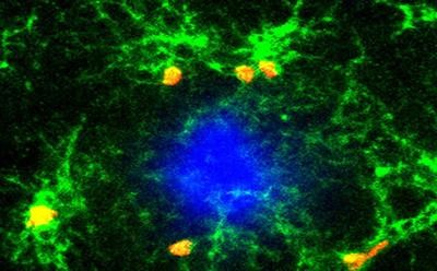 En verde, las células microglia que se acumulan y proliferan alrededor de la placa beta amiloide(en azul). Crédito de imagen: University of Southampton.