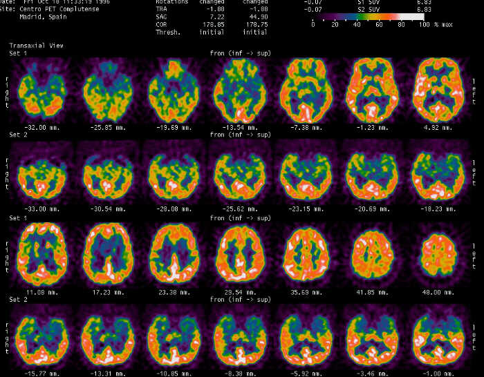 1284neuroimatgefuncional