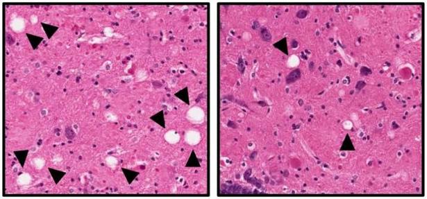 Disminución de muerte neuronal (en blanco) con el fármaco experimental (izquierda) - UNIVERSITY OF IOWA