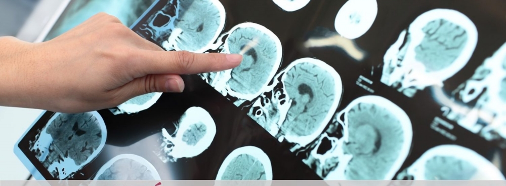 170220180223-descubren-un-nuevo-mecanismo-implicado-en-la-enfermedad-de-alzheimer-0-1500x550