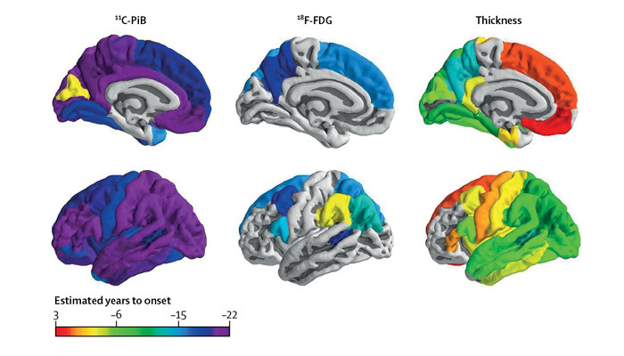 1756comienzo-alzheimer