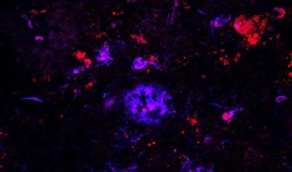 1772antibodyallzheimer-kbhf-620x349abc