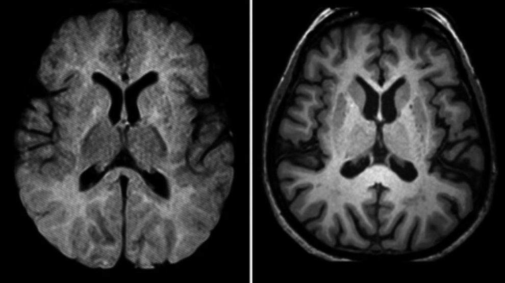 1798alzheimer-2-990x556
