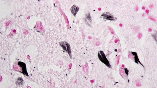 Ovillos neurofibrilares de proteína tau en el hipocampo de un paciente con alzhéimer - WIKIMEDIA