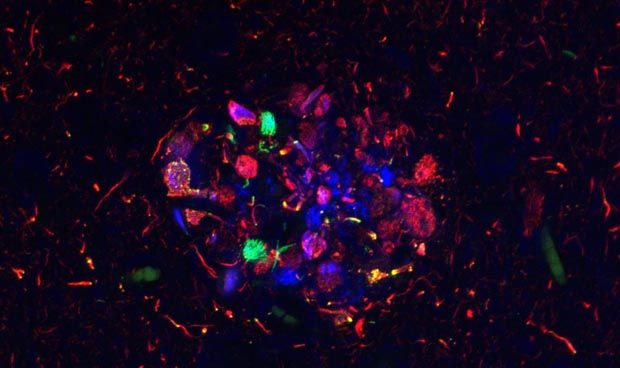Placa senil obtenida con microscopía láser confocal de la región CA1 del hipocampo. CSIC.