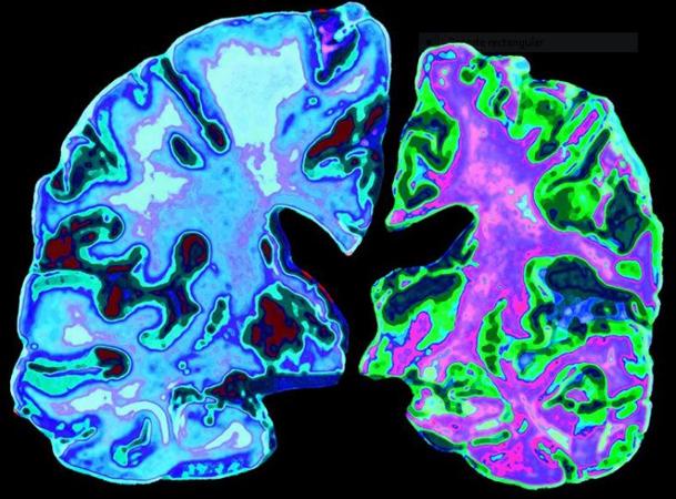 2192alzheimer-nature-kdlh-u301746724274mtg-620x450abc