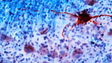 Enredo neurofibrilar en tronco cerebral. Imagen: Grinberg Lab / UCSF