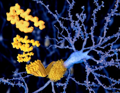 2259amiloide-490x380