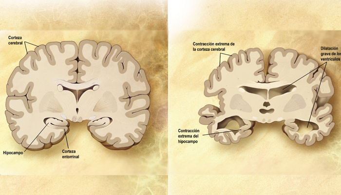 Esquema de un corte frontal de dos cerebros. El de la izquierda es un cerebro sano y el de la derecha uno que padece la enfermedad de Alzheimer | Wikimedia Commons
