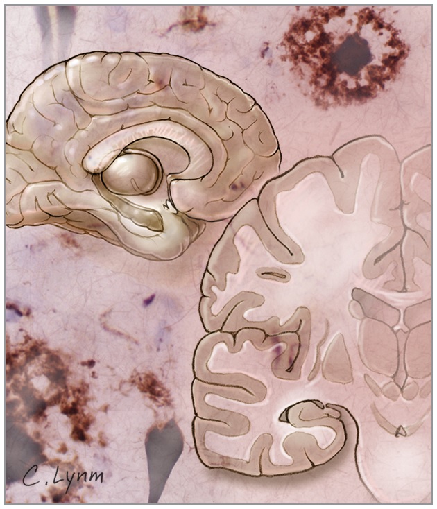 Preparados derivados de la hormona del crecimiento humano (hGH) contaminados con priones.