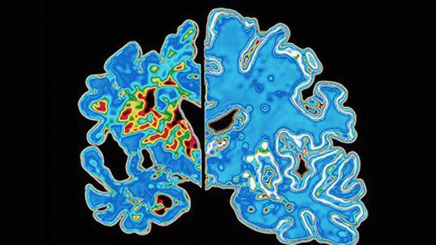 Cerebro con placas de alzhéimer