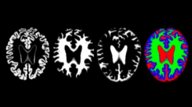 2474alzheimer-marcador-k71c-620x349abc