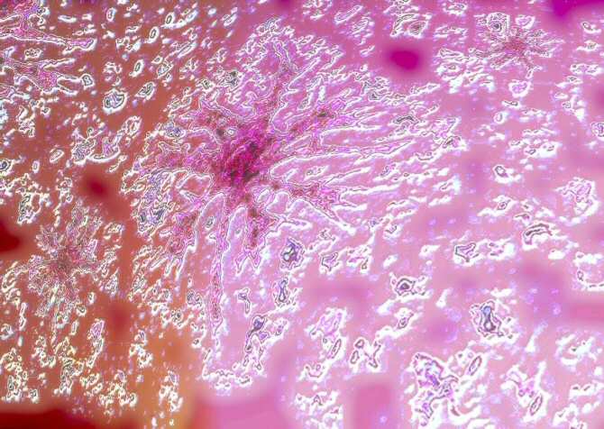 Recreación artística de células cerebrales en un cerebro afectado por la enfermedad de Alzheimer. (Imagen: Amazings / NCYT)