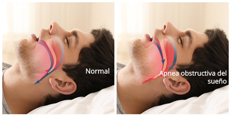3294apnea-obstructiva-del-sueno